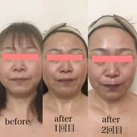 最高級小顔シワ伸ばしエステ！！二重アゴ撃退！ラジオ派＋高周波最新技術