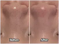 【毛穴詰まり・黒ずみ撃退！】韓国式毛穴洗浄🫧ハイドロフェイシャル ✨