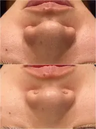 毛穴レスフェイシャルコース