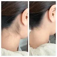 その場で美人うなじへ👩🏻🦰🤍うなじブラジリアンワックス