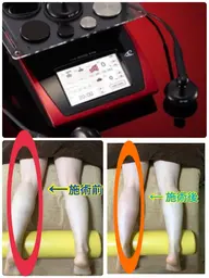 温熱リンパドレナージュ(上半身or下半身)初回のみ→オールラジオ波で温熱リンパドレナージュ 肩こり.冷え性な方にオススメ