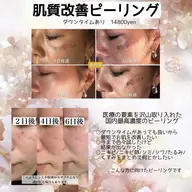 【国内最高濃度ピーリング】韓国美肌/ニキビケア