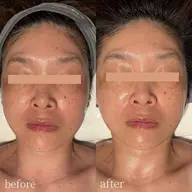 【満足度◎】フェイス＋うなじワックス脱毛｜デコルテ・背面マッサージ付✨透明感フルケア