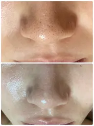 【毛穴悩み】ハーブピーリング