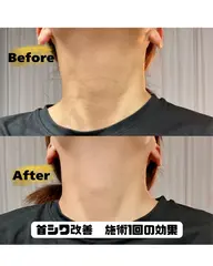 45歳​〜​55歳の方限定🙋🏼‍♀️　ストレートネック➕首皺撃退⚡️