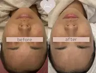 【毛穴・くすみリセット】透明感アップフェイシャル¥22000→