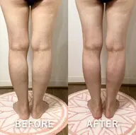 痩身◆ 【美尻/足背面美脚コース】キャビ＋ラジオ派＋痩身マッサージ50分 6000円→