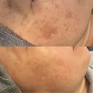 シミケア放題30分➕ラジオ派