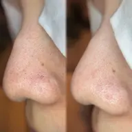 【人気メニューがセットでお得】エクストラクション（鼻）＋剥けないハーブピーリング