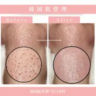 韓国肌管理【ハイドラ毛穴洗浄】【美容液導入】憧れの水光肌へ〜🫧