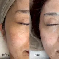 【くすみケア】透明感溢れるうる透け肌へ♡ ¥11,000→¥5,500