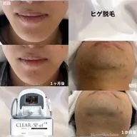 【メンズヒゲ脱毛】SNS掲載OKな方のみ(美肌ケアなし)