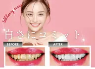 【秋田市/秋田県在住の方限定】地方応援セルフホワイトニング(9分×2回) ¥3980→無料