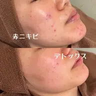 【今だけ！癒し&お肌改善❕✨】お肌改善コース＋Yurumiヘッドマッサージ＋デコルテオイルマッサージ付き🌸