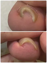 巻き爪矯正カウンセリング