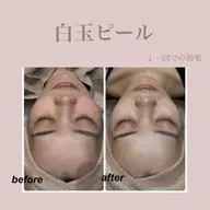 🤍4月限定🤍【白玉ピーリング】肌管理ならお任せ下さい💞シミ、毛穴、たるみ、しわをダウンタイムゼロで根本改善💫