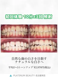 【平均2​〜​3トーンアップ】　SNS映え◎お試しセルフホワイトニング✨〈15分×2回〉