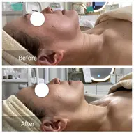 【フェイスライン/たるみ/顎下/口元/クマ】都内で人気リフトマシン🌟サーマトリックス60分¥17000→¥12500