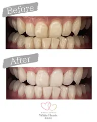 ホワイトニング