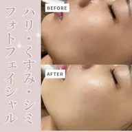 【内側のケア❣️】光フェイシャル💡✨パック付き