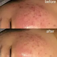 【4.16/17限定】大人気光フェイシャル➕美肌モデパック付 ➕デコルテマッサージ　45分(顔脱毛込み)