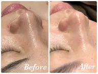 【いちご鼻黒ずみ撃退】鼻のみ★