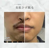 【メンズ限定】つるすべヒゲ脱毛👨🏻