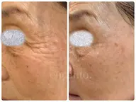 フェイシャルワックス＋スキンケア体験