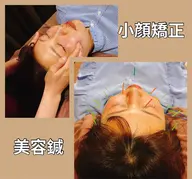 °ʚ🎀即効性バツグン🎀ɞ°.美容鍼➕小顔矯正➕首、肩マッサージ✨