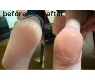 足裏角質ケア