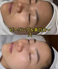 今話題🩷剥離なしヒト臍帯血ハーブピーリング🩷 ツヤツルツルふんわり肌へ❤️‍🩹毛穴洗浄＆美白コース込み¥ 3980