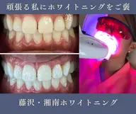 【ミニモ限定価格】ホワイトニング¥8800円→4600円🦷✨