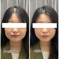 小顔造形!【3D×顔特化】W打ち🌿🤍No.1メニュー//😊