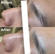 メンズ大歓迎！【毛穴洗浄で毛穴レス✨】ハイドラ毛穴洗浄で皮脂汚れスッキリ！