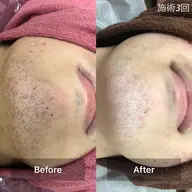 【メンズ】☆お試し2回☆ヒゲ脱毛(ほほ・口周り・あご下・くび)+カウンセリング ♪保湿ケア付♪