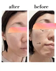 【ミニモ学割】ニキビ肌・毛穴・くすみ改善✨フェイスラインをスッキリさせたい方にもオススメ✨光フェイシャル✨2回体験