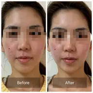 《ご新規様限定キャンペーン》小顔ラジオ波/即効彫刻コース1回で実感！二重あご気になる方ぜひ◎18700円⇨15800円