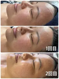 【毛穴レス】REVI  生酵素ハーブピーリング