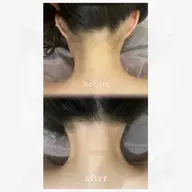 ㊗️成人式の方👀うなじ広範囲とほほのハイブリッド脱毛🌈もみあげ部分も綺麗に整えます☺️前撮りの前にも🙆‍♀️