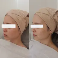 \ニキビ毛穴など肌悩みのある方/無料エステモニター🌿