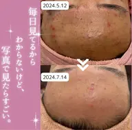 【メンズ】陶肌トリートメント／ハーブピーリング