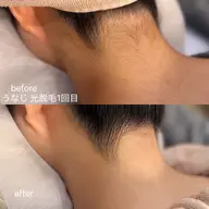 【レディースうなじ、えりあし脱毛】最新光脱毛 THR式🤍✨後ろ姿も美人に👍🏻 ̖́-