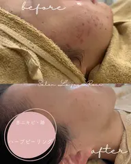 本気の肌改善【初回】陶肌♡ハーブトリートメント(ニキビ・赤み)