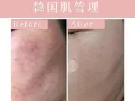 ［今月限定　水光肌🉐セット　ハイドラフェイシャル＋フェイシャルワックス］25000円→9800円