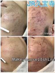 《ハーブピーリング🌿シミや毛穴へハーブピーリング🌿顔/背中/お尻》メンズ専用