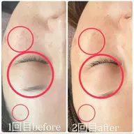 ハーブピーリング【シミ、しわ、たるみ】