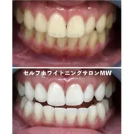 【ご新規様★人気No.1】ハイパワーコース🦷✨〜初回限定超集中コース〜(15分×3照射)