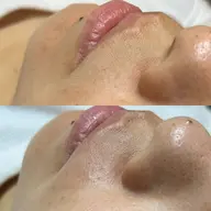 👻【土日限定】フェイスWax 2箇所選択ok (おでこ/口周り/フェイスライン/もみあげ/うなじ/鼻毛)🎃