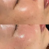 ララピール　近赤外線LEDコラーゲン付き✨