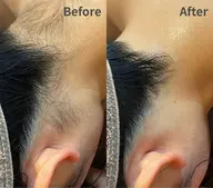 【女性人気No.3】意外と見られてる？！襟足美人うなじ脱毛¥2,660